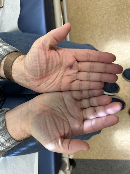 photo of my hands taken by the nurse at the urgent care. The right hand is swollen and black and blue. This is with the swelling reduced!